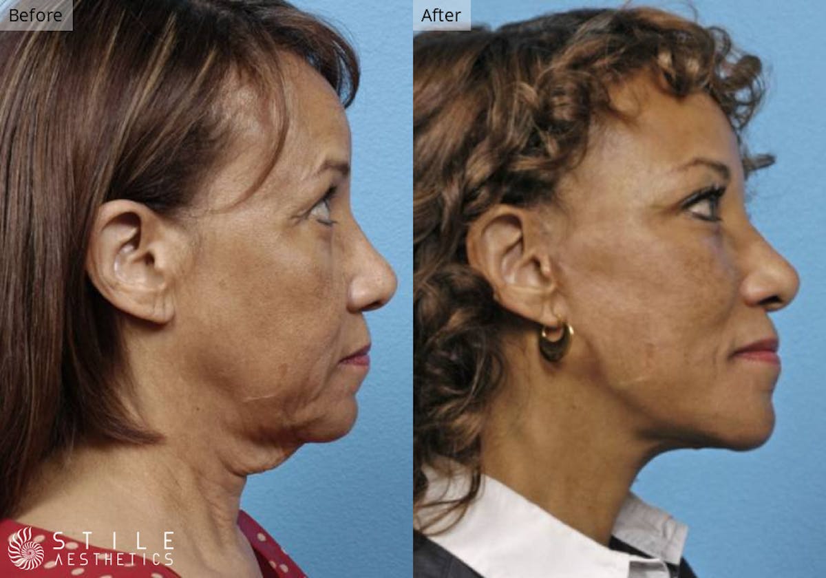 Neck Lift result at Stile Aesthetics