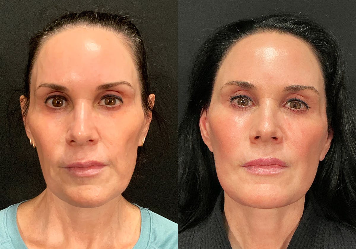 Facelift result at Stile Aesthetics