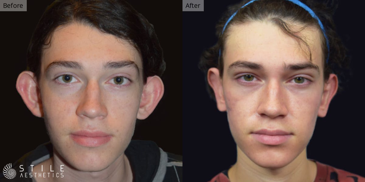 Otoplasty result at Stile Aesthetics