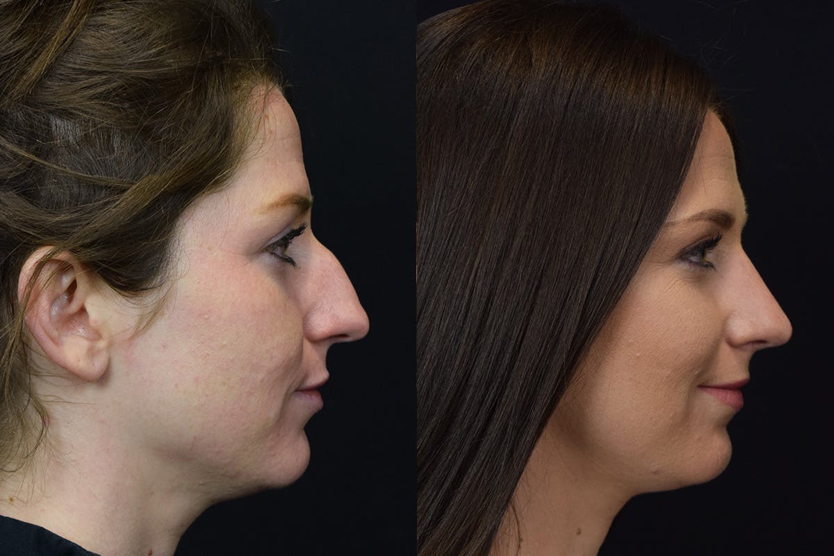 Rhinoplasty result at Stile Aesthetics