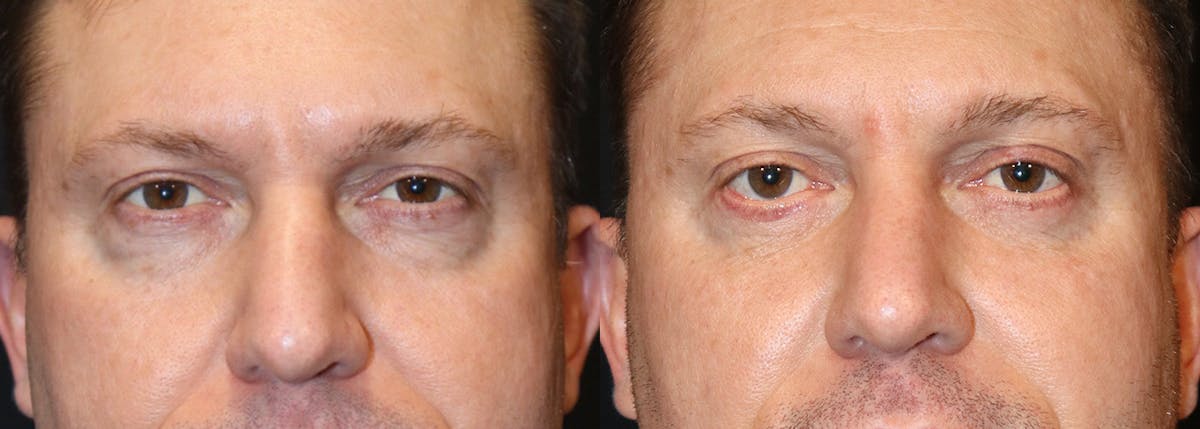 Blepharoplasty result at Stile Aesthetics