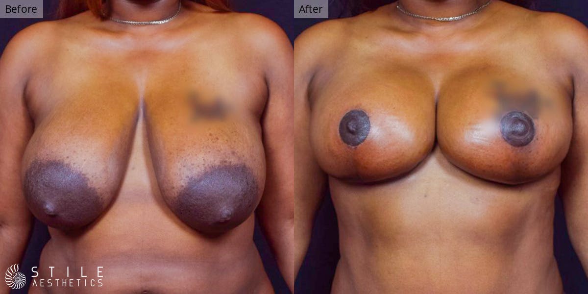 Breast Lift result at Stile Aesthetics
