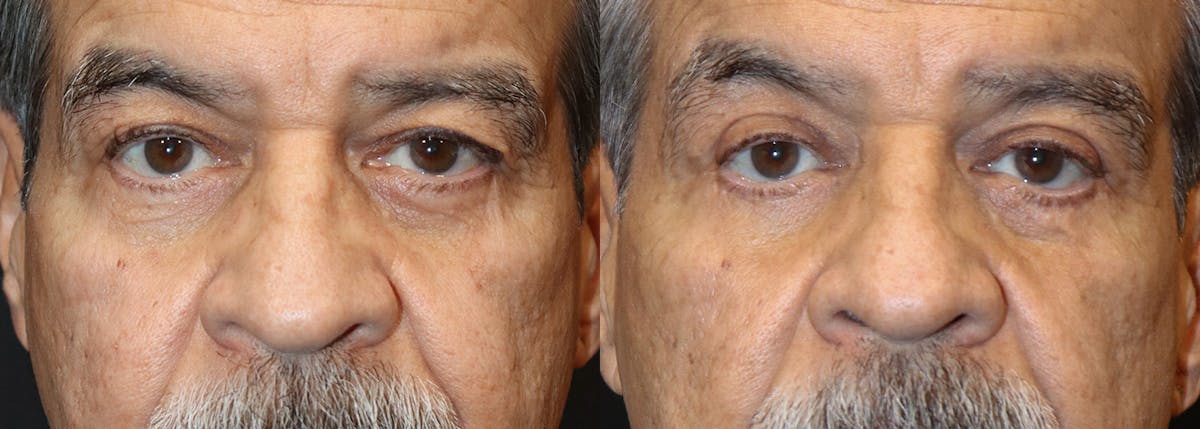 Blepharoplasty result at Stile Aesthetics