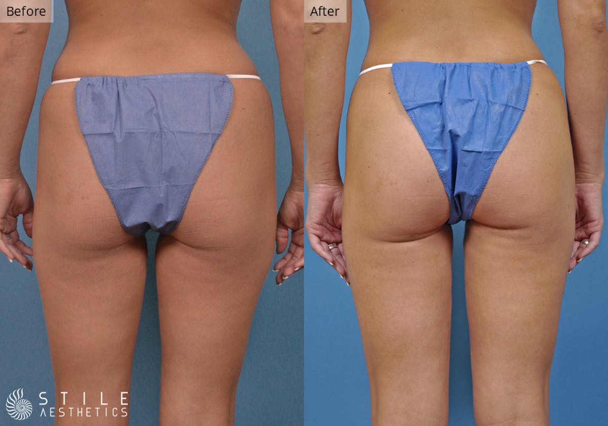 Liposuction result at Stile Aesthetics