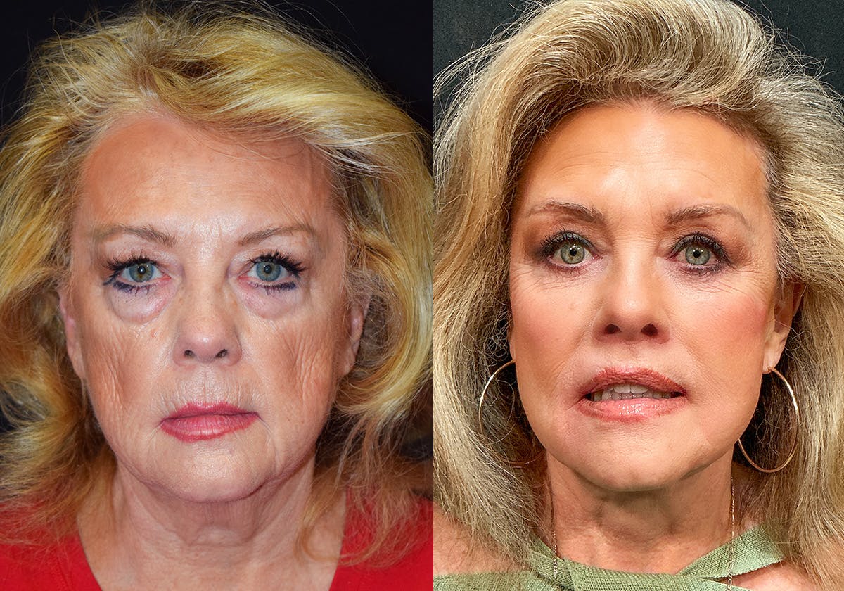 Facelift result at Stile Aesthetics