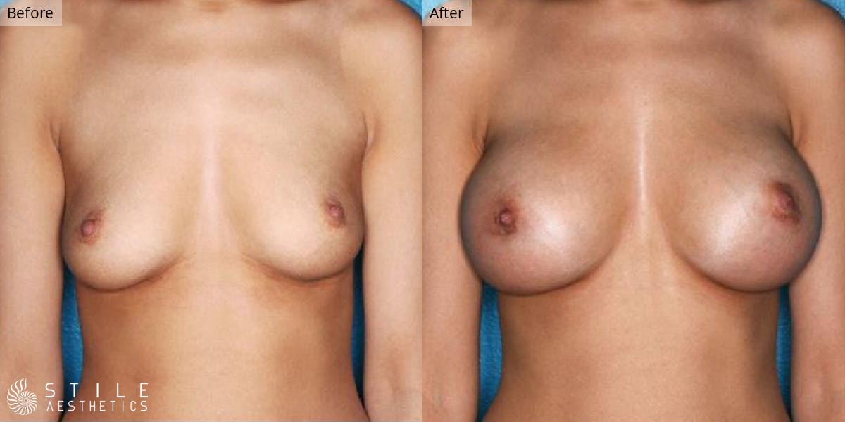 Breast Augmentation result at Stile Aesthetics