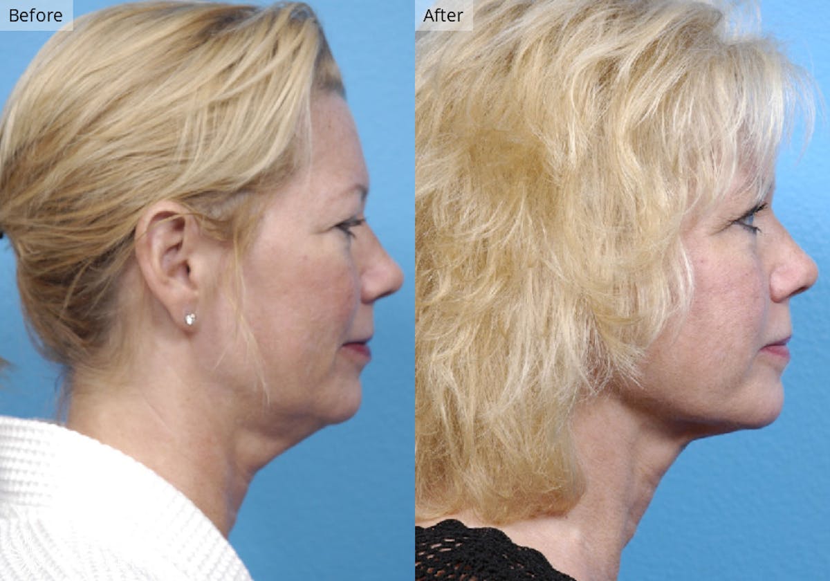 Liposuction result at Stile Aesthetics