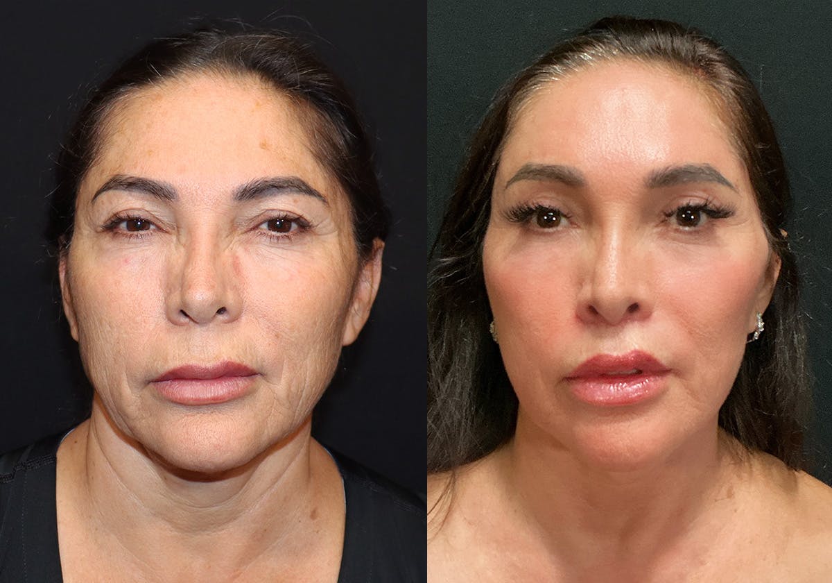 Facelift result at Stile Aesthetics