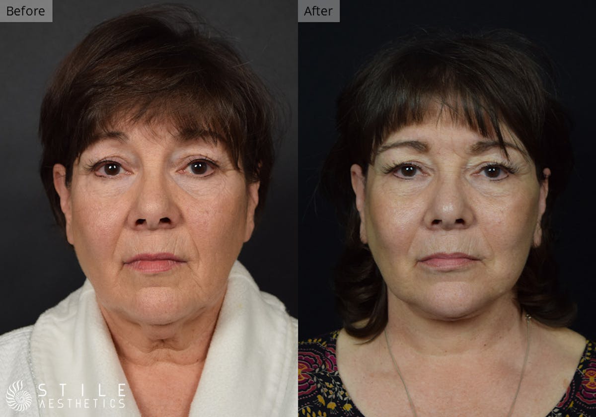 Facelift result at Stile Aesthetics