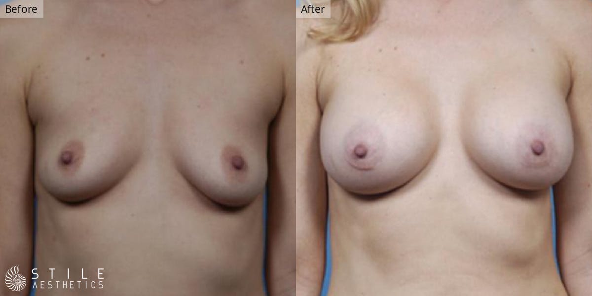 Breast Augmentation result at Stile Aesthetics