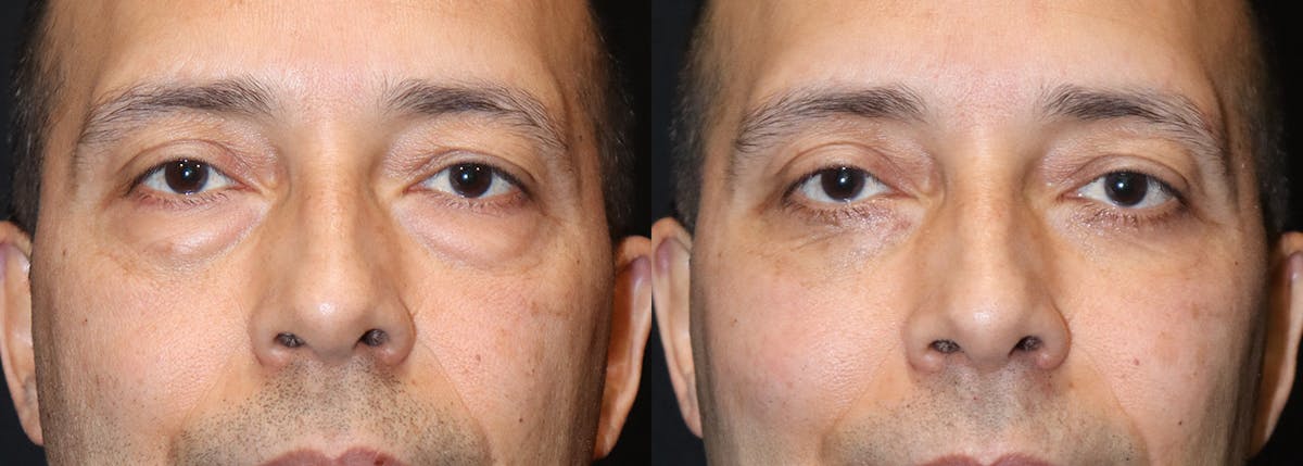 Blepharoplasty result at Stile Aesthetics