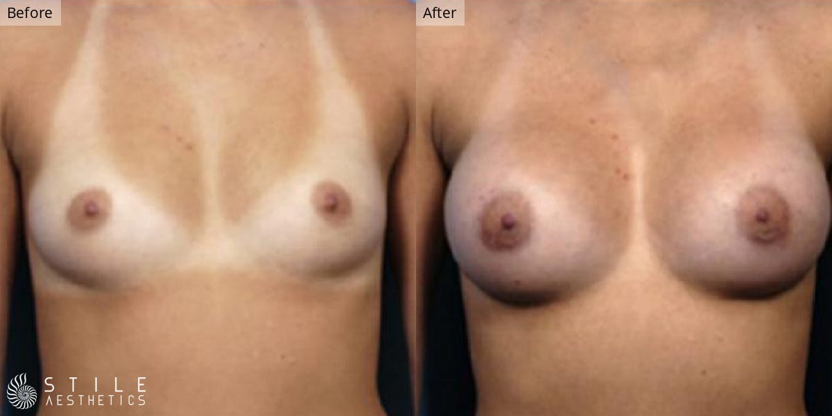 Breast Augmentation result at Stile Aesthetics