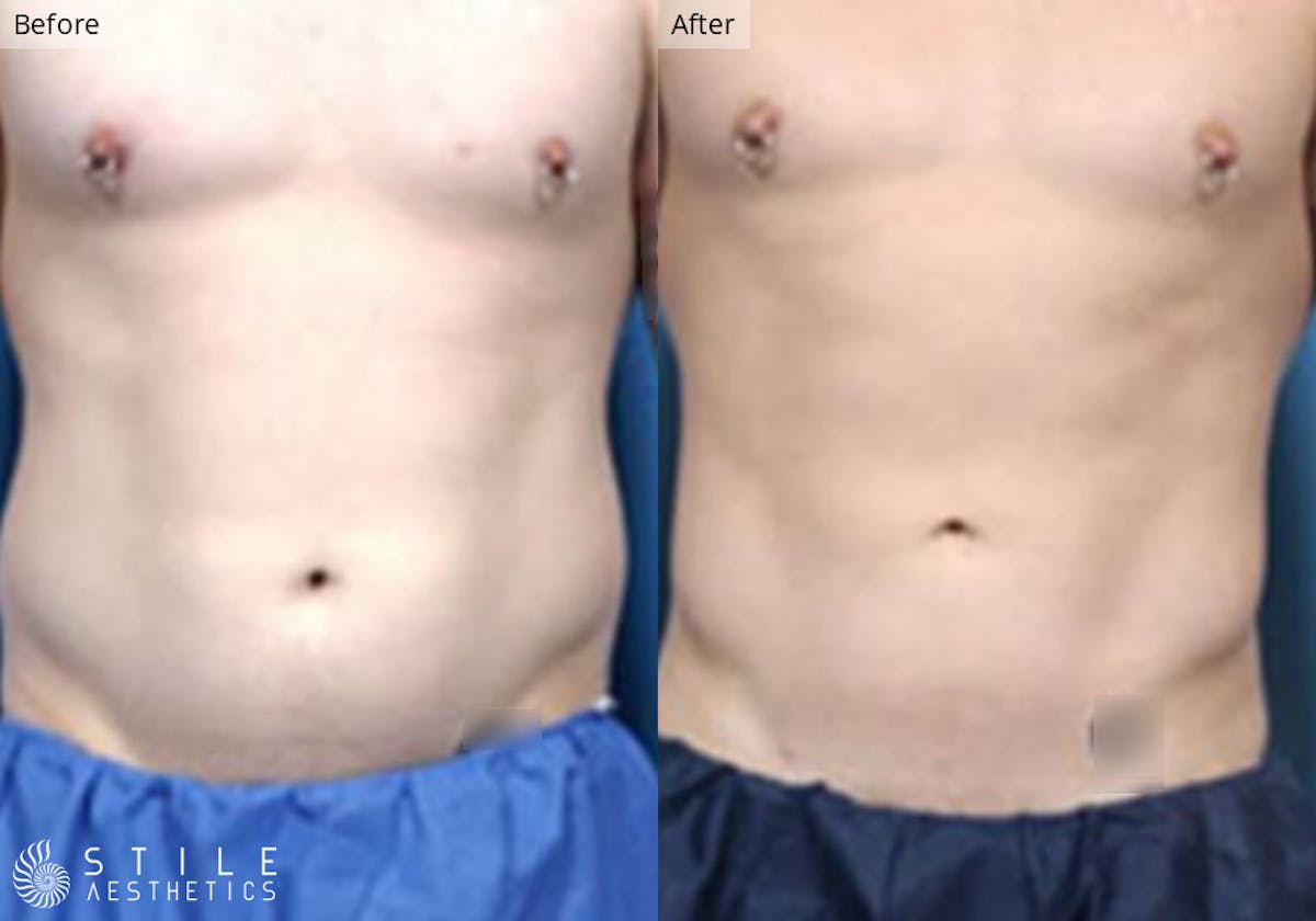 Liposuction result at Stile Aesthetics