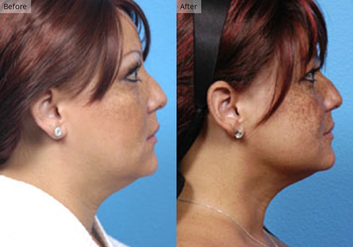 Liposuction result at Stile Aesthetics