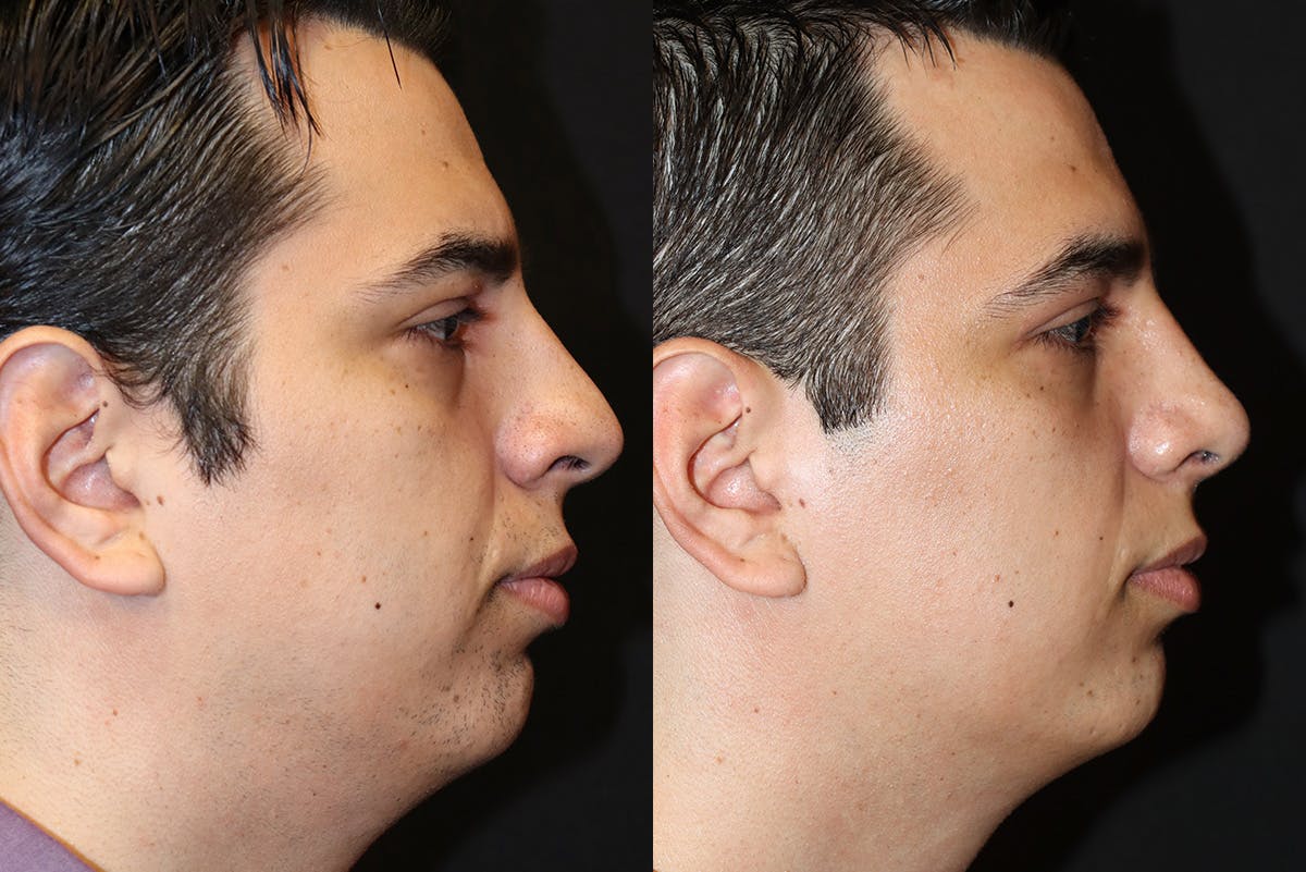 Rhinoplasty result at Stile Aesthetics