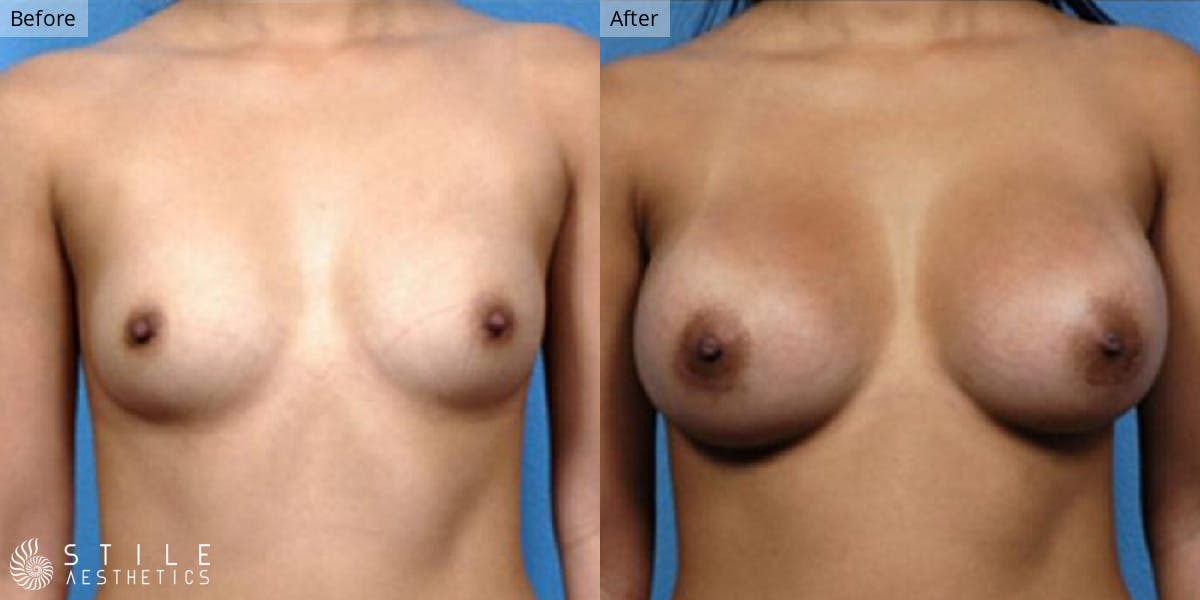 Breast Augmentation result at Stile Aesthetics