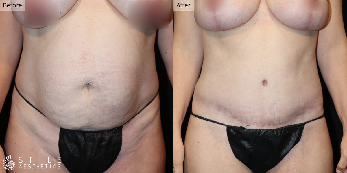 Tummy Tuck result at Stile Aesthetics