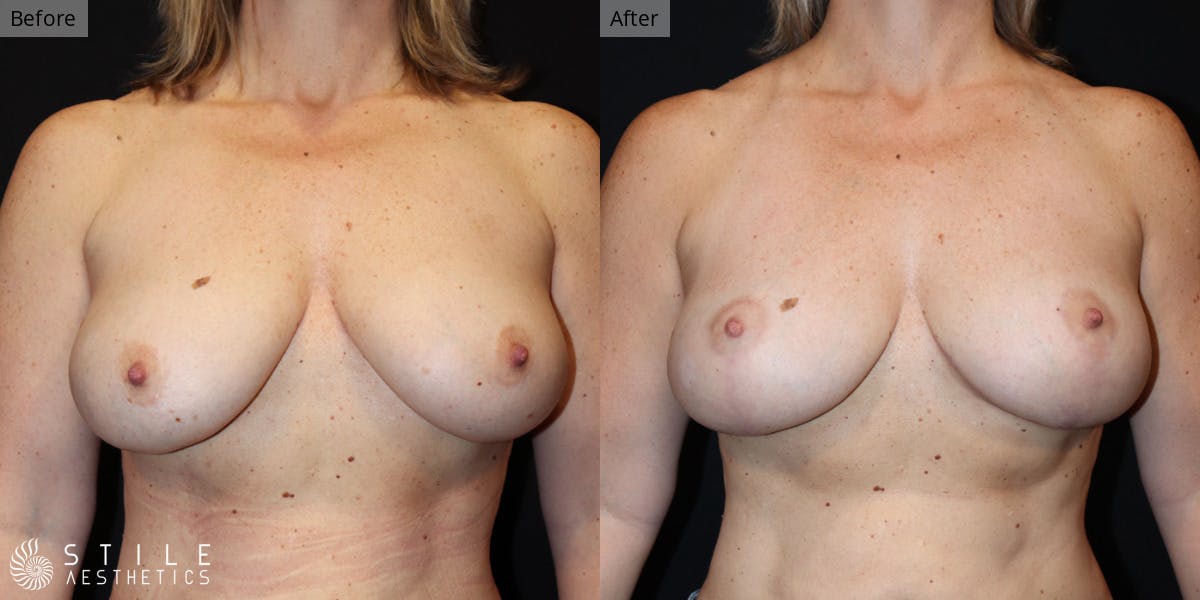 Breast Lift result at Stile Aesthetics
