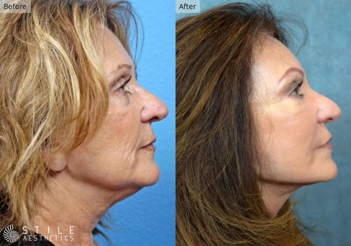 Neck Lift result at Stile Aesthetics