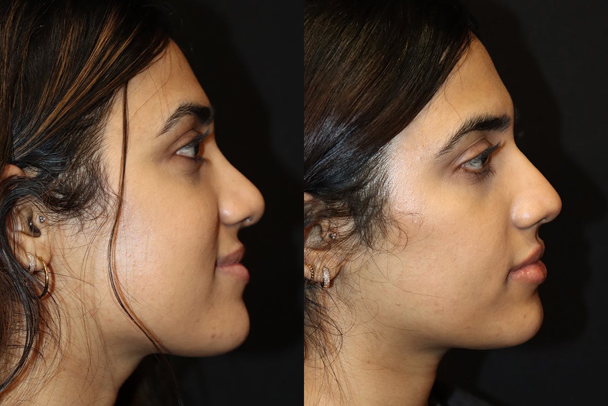 Rhinoplasty result at Stile Aesthetics