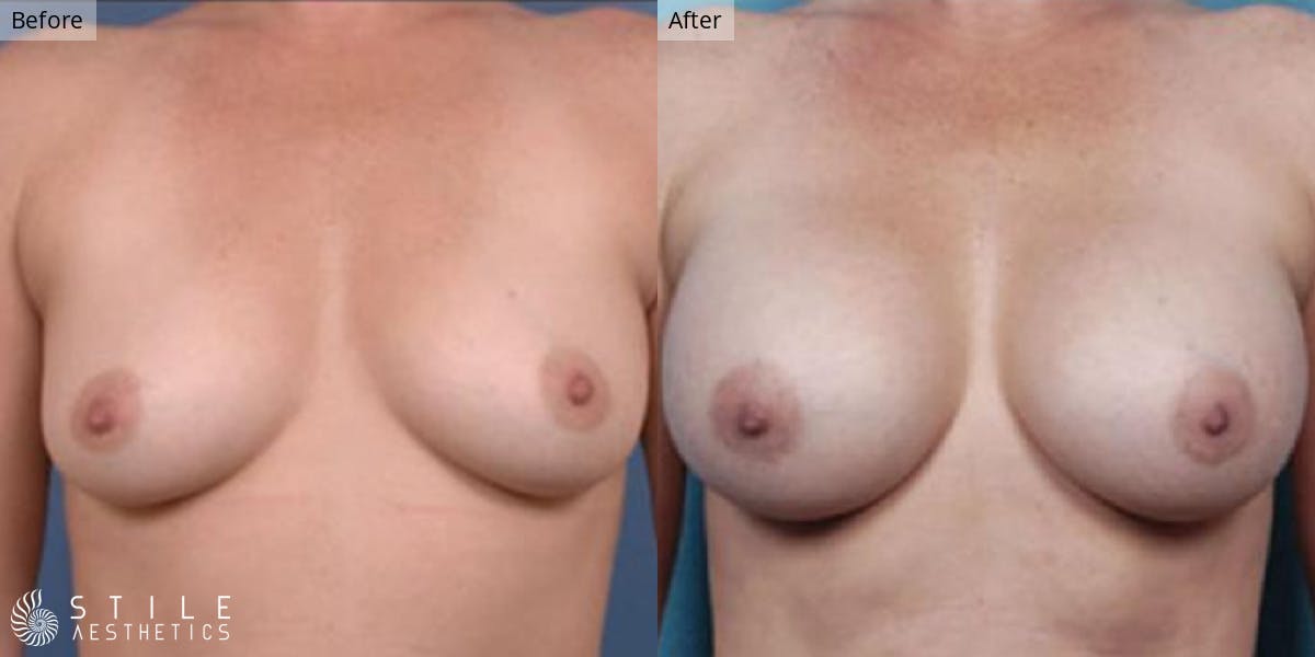 Breast Augmentation result at Stile Aesthetics