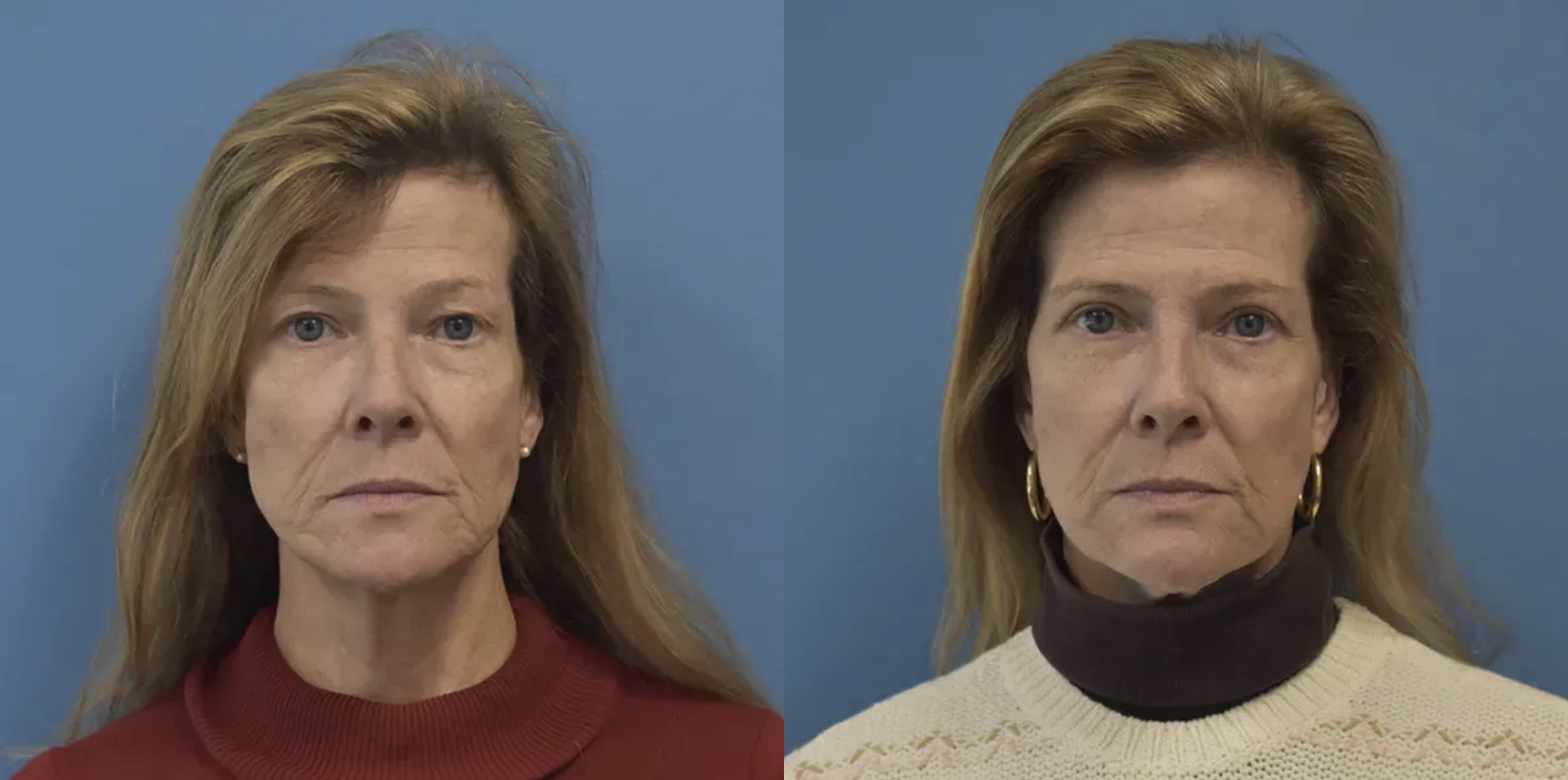 A result from West End Facial Plastic Surgery