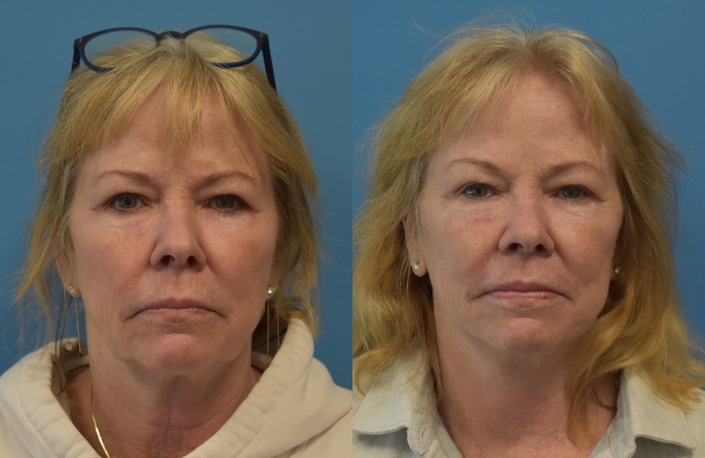 A result from West End Facial Plastic Surgery