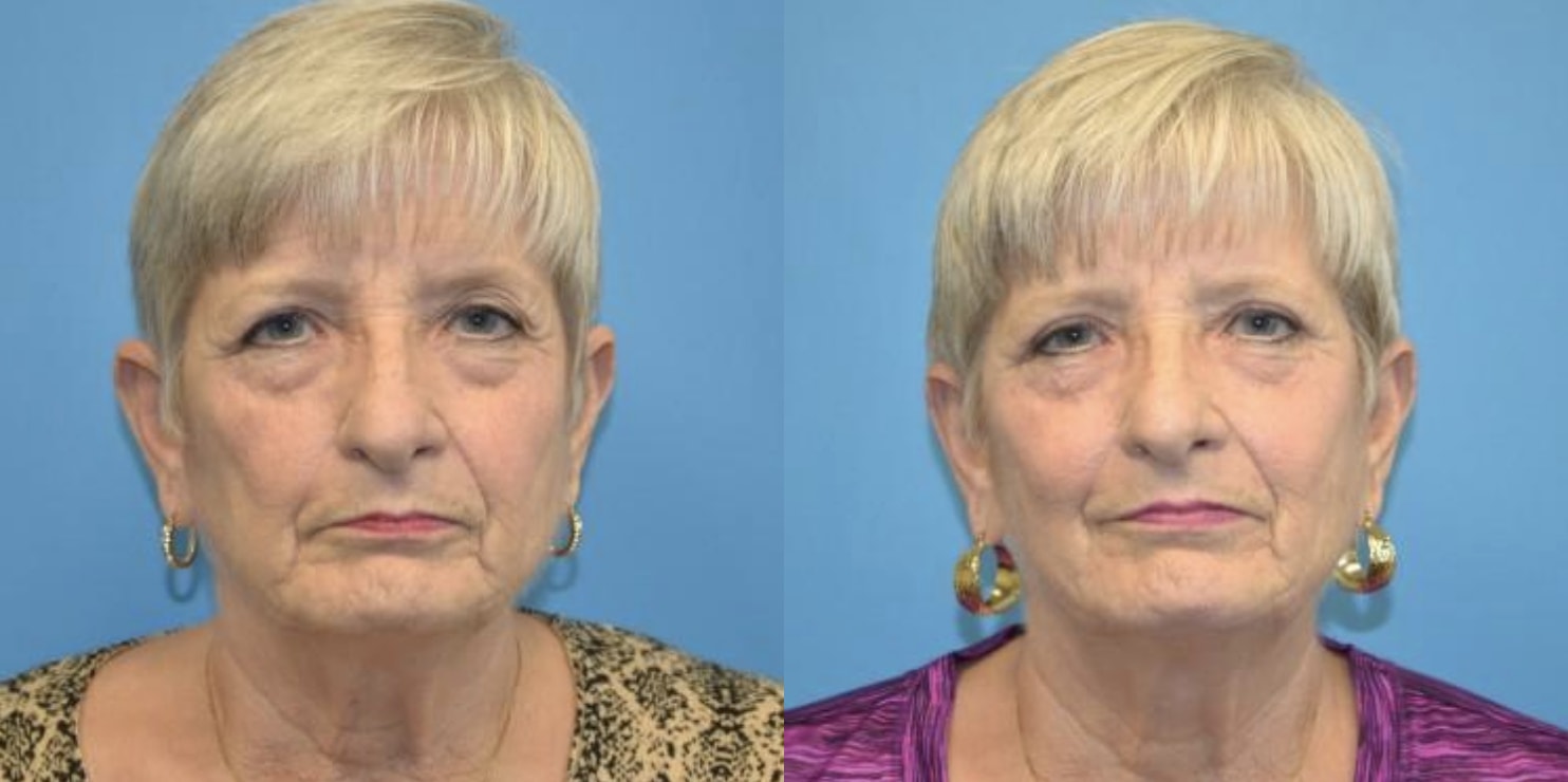 A result from West End Facial Plastic Surgery