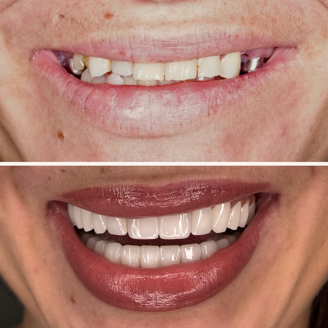 A result from Elite Smiles by Walter Meden DDS