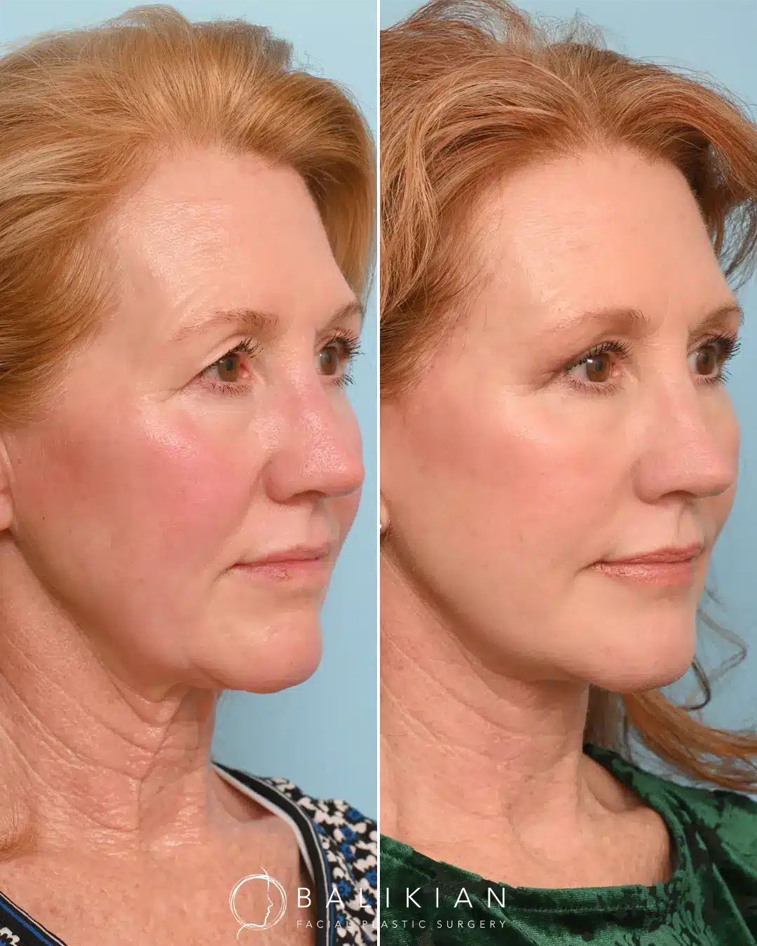 A result from Balikian Facial Plastic Surgery