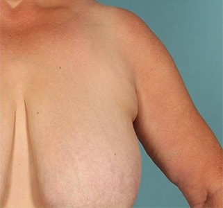 A result from Paydar Plastic Surgery: Keyian Z Paydar, MD