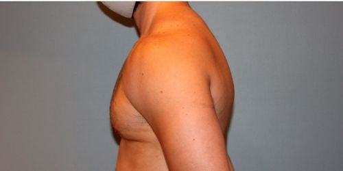 A result from Paydar Plastic Surgery: Keyian Z Paydar, MD