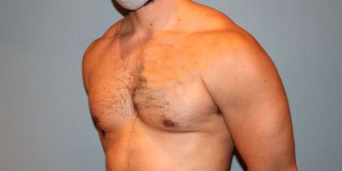 A result from Paydar Plastic Surgery: Keyian Z Paydar, MD