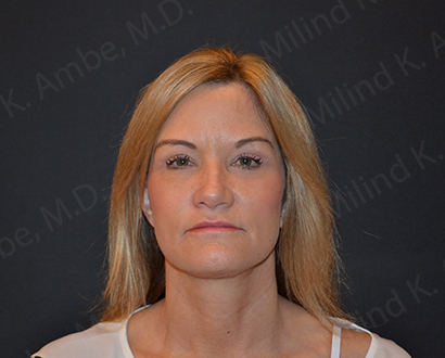 Neck Lift result at Newport Beach Plastic Surgery