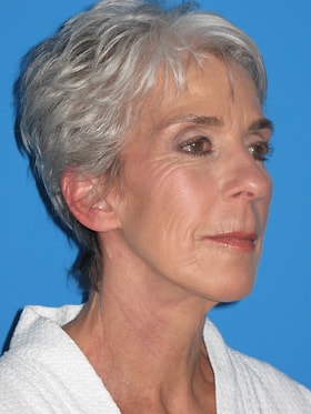 A result from Plastic Surgeon Baltimore, MD: Dr. Alyson Wells