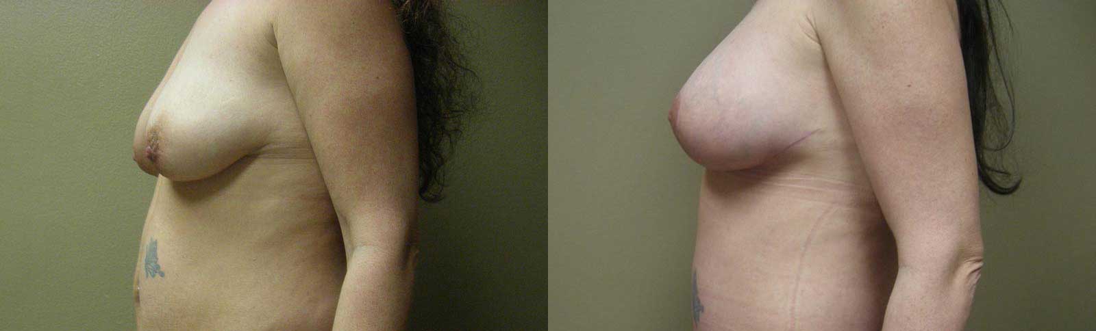 A result from Arkansas Plastic Surgery
