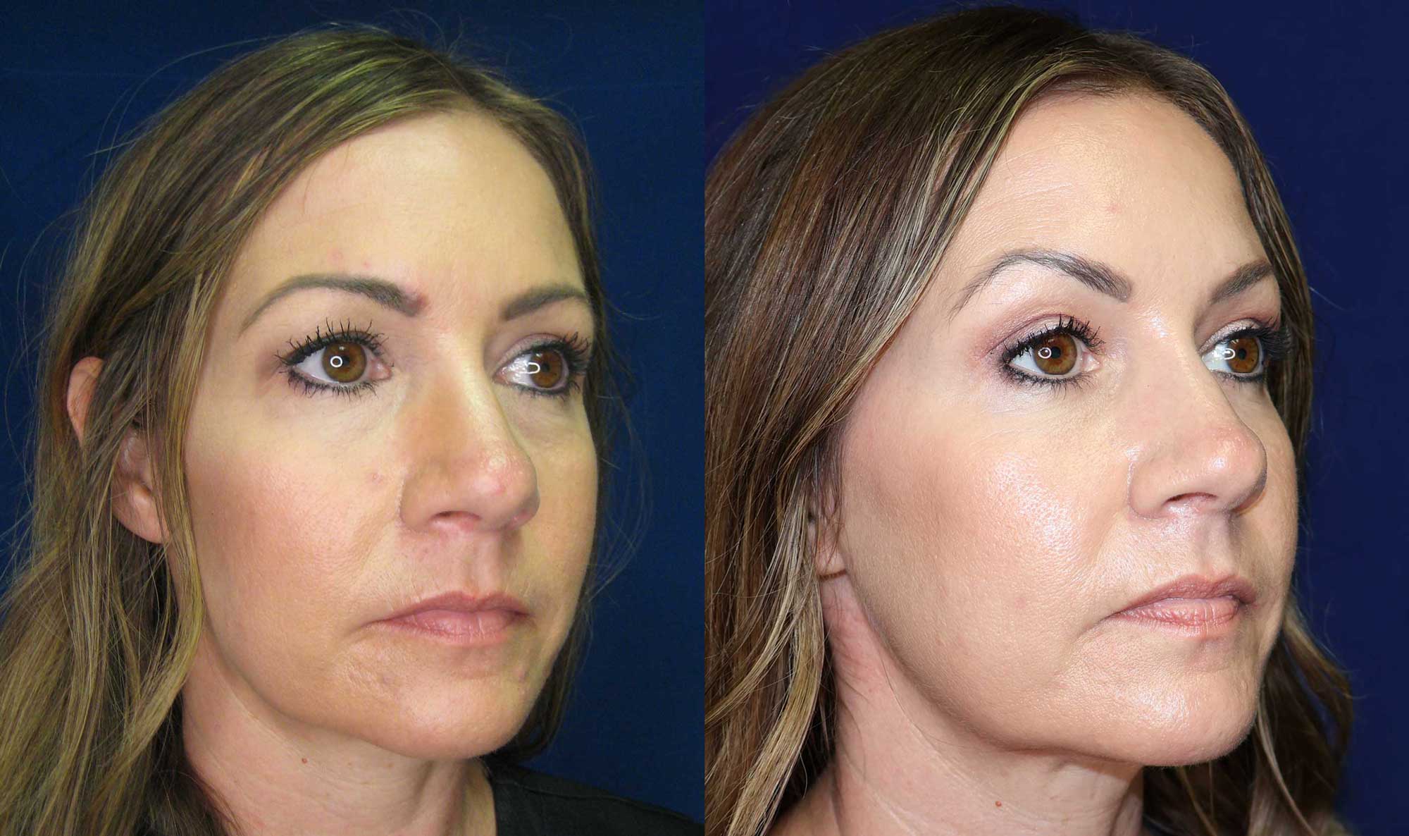 A result from Arkansas Plastic Surgery