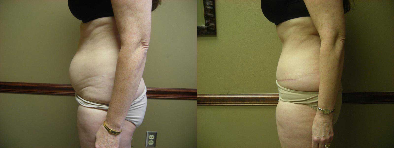 A result from Arkansas Plastic Surgery