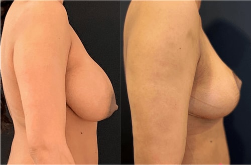 A result from Neinstein Plastic Surgery