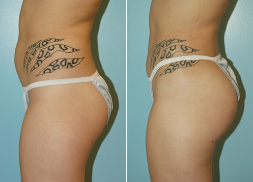 A result from Plastic Surgery of Westchester