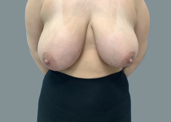 Breast Lift before photo