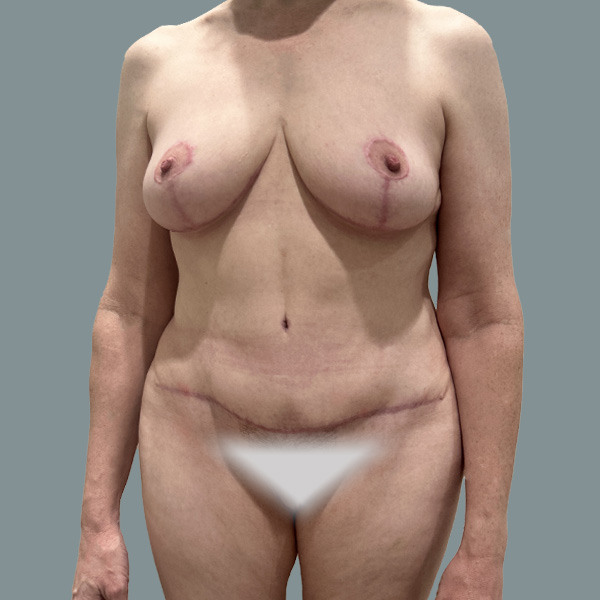Mommy Makeover result at La Femme Plastic Surgery