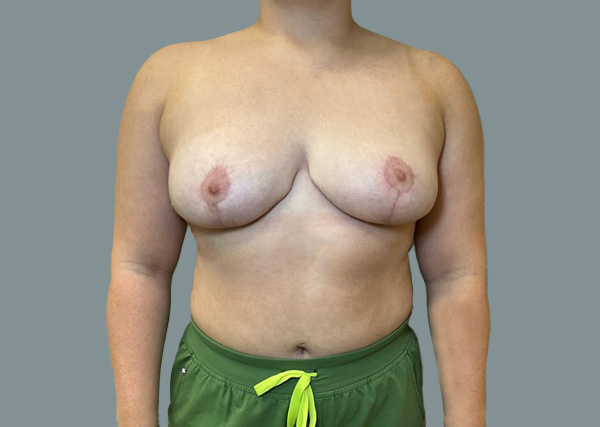 Breast Lift result at La Femme Plastic Surgery