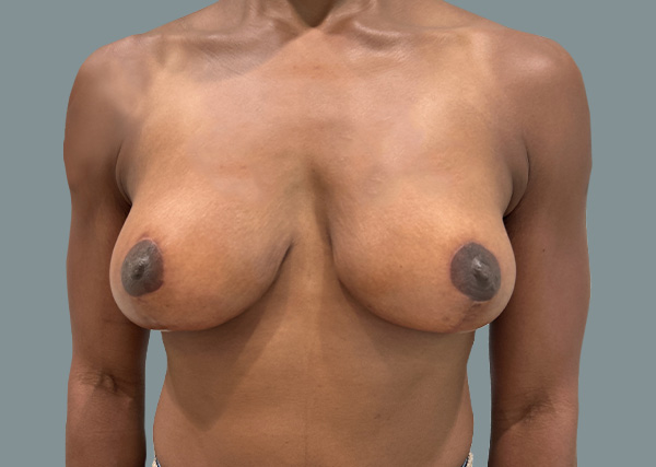 Breast Lift result at La Femme Plastic Surgery