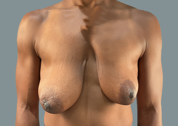 Breast Lift before photo
