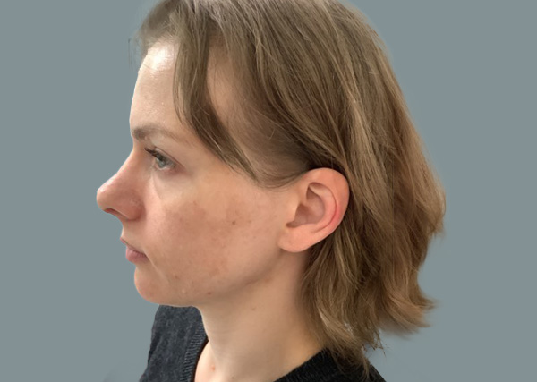 Rhinoplasty result at La Femme Plastic Surgery