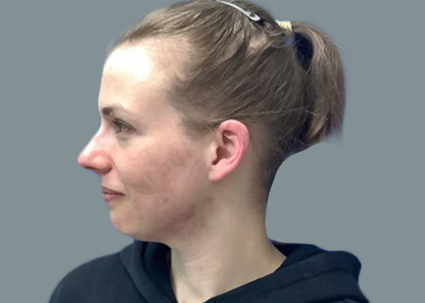 Rhinoplasty before photo