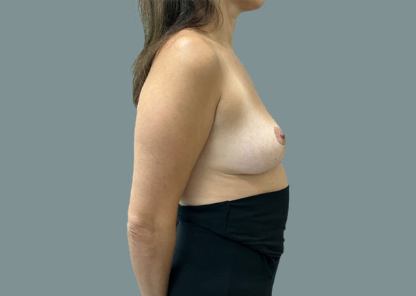 Implant Revision result at La Femme Plastic Surgery