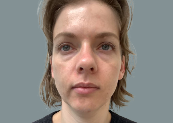 Rhinoplasty result at La Femme Plastic Surgery
