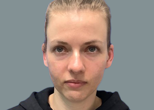 Rhinoplasty before photo